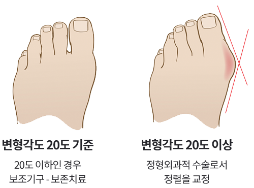 무지외반 변형각도 20도 기준 비교, 20도 이하 보조기구 보존치료와 20도 이상 수술 교정