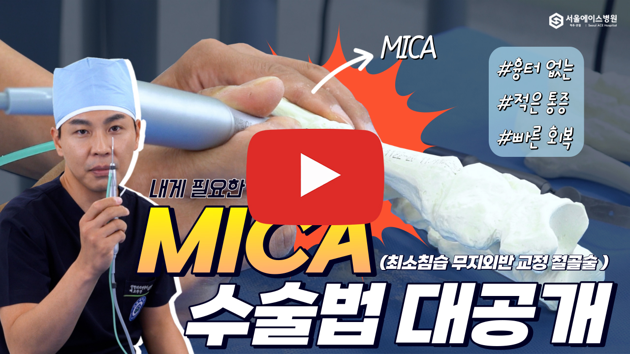 [MICA 수술 2편]