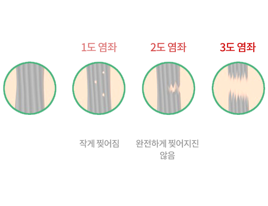 인대 손상 정도 비교, 정상, 1도 염좌, 2도 염좌, 3도 염좌(완전 파열)