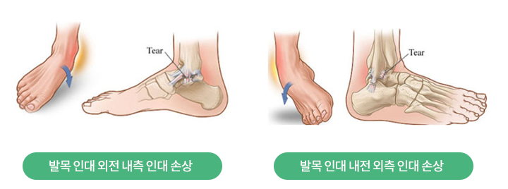 발목 내측 인대 손상과 외측 인대 손상 기전 그림