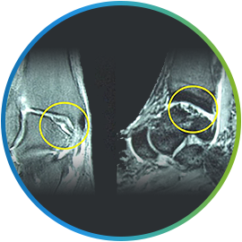 발목 연골 손상 부위를 표시한 발목 MRI