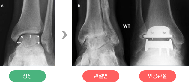 정상 발목, 발목 관절염, 인공관절 치환 후 X-ray 비교
