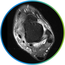 발목 인대 상태를 확인하는 발목 MRI 가로단면 영상