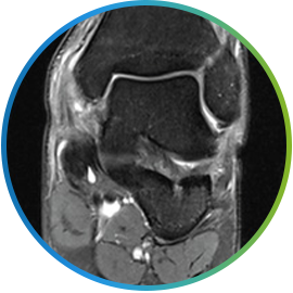 발목 인대 상태를 확인하는 발목 MRI 세로단면 영상