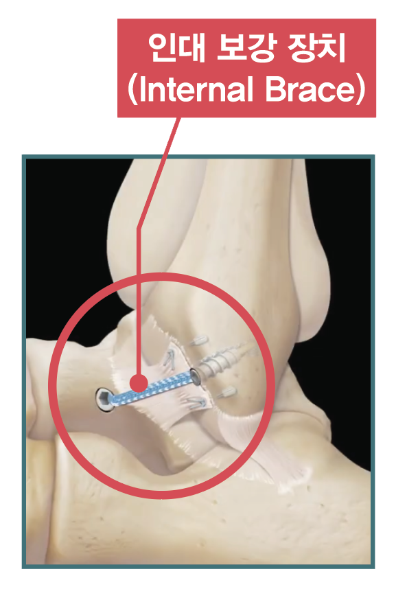 인대 보강 장치(Internal Brace)를 적용한 발목 인대 봉합 그림