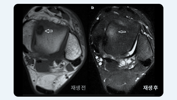 연골 재생 전과 후 발목 MRI 비교