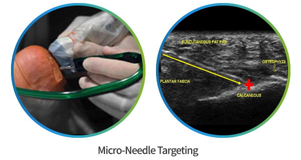 초음파 유도 하에 Micro-Needle 타겟점을 확인하는 시술 사진과 초음파 영상