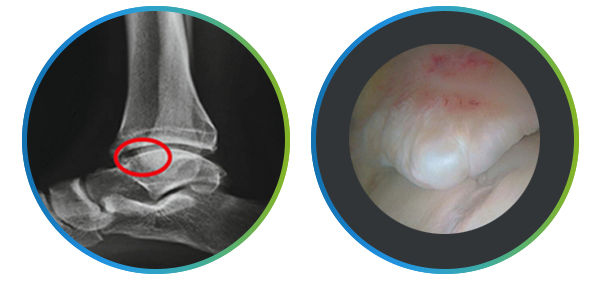 발목 X-ray 골극 부위 표시와 관절내시경 영상