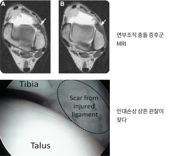 연부조직 충돌 증후군 MRI와 관절내시경에서 확인한 인대 손상 흔적
