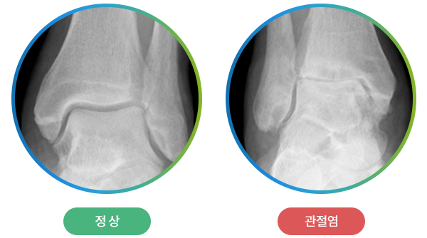 정상 발목과 발목 관절염 X-ray 비교