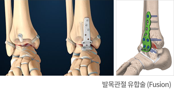 발목관절 유합술(Fusion) 전 후 X-ray와 고정 플레이트 그림