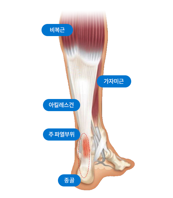 아킬레스건과 비복근, 가자미근, 종골, 주 파열부위를 표시한 해부 그림