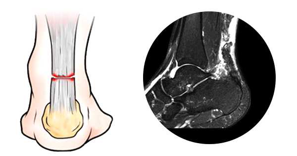 아킬레스건 완전 파열 그림과 발목 MRI