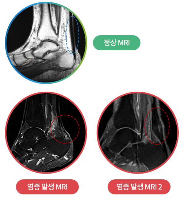 정상 MRI와 염증이 발생한 아킬레스건 MRI 비교