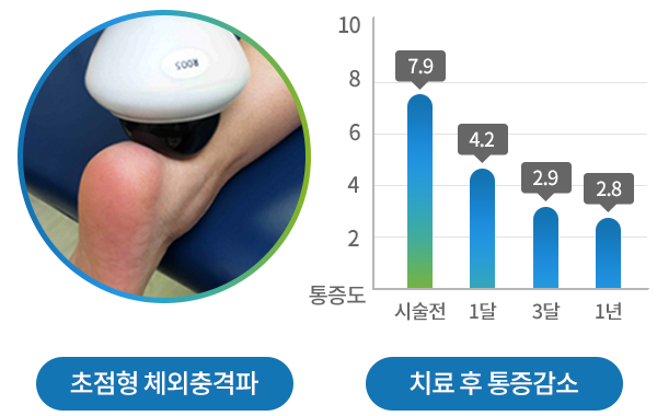 초점형 체외충격파 치료 모습과 치료 후 통증도 감소 그래프