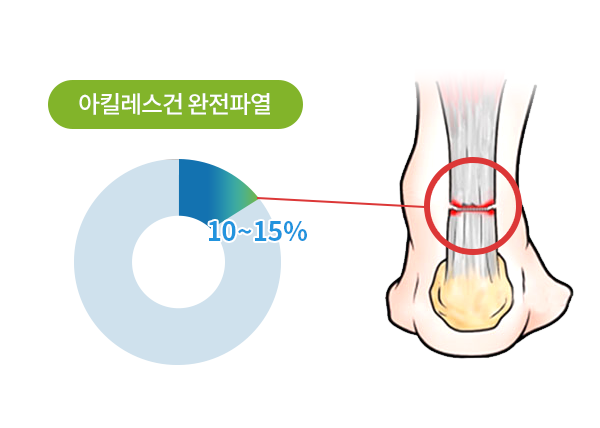 아킬레스건 완전 파열 10~15%를 나타낸 그래프와 파열 부위 그림
