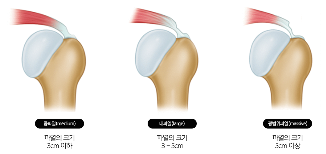 파열 크기별 회전근개파열 분류: 중파열 3cm 이하, 대파열 3~5cm, 광범위파열 5cm 이상