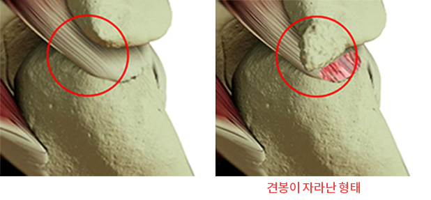 견봉 뼈가 힘줄 쪽으로 자라난 형태를 정상과 비교한 일러스트