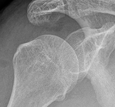 견봉 성형술 후 어깨 X-ray 영상