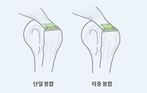 단일 봉합과 이중 봉합 방식을 비교한 회전근개 봉합 모식도