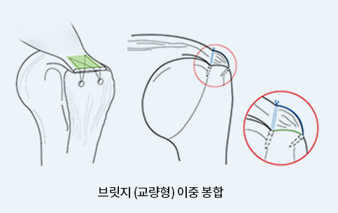 브릿지(교량형) 이중 봉합 방식을 보여주는 회전근개 봉합 모식도