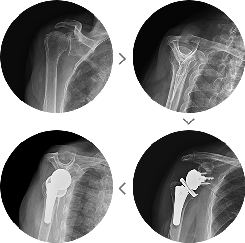 역행성 인공관절 치환술 전후 어깨 X-ray 영상