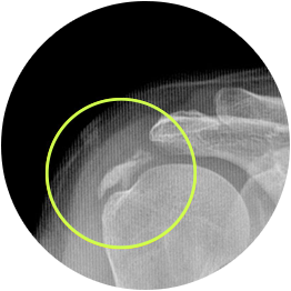 어깨 힘줄에 침착된 석회를 원으로 표시한 X-ray 영상