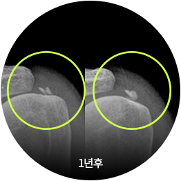 석회성 건염 1년 후 어깨 X-ray 영상(석회 부위 표시)