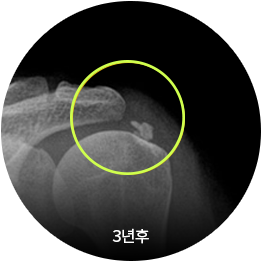 석회성 건염 3년 후 어깨 X-ray 영상(석회 부위 표시)