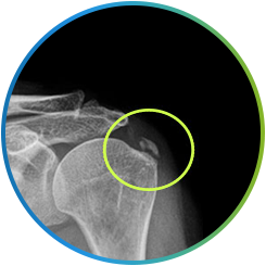 석회화 부위를 원으로 표시한 어깨 X-ray 영상