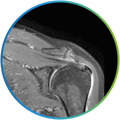 석회성 건염이 있는 어깨 MRI 영상
