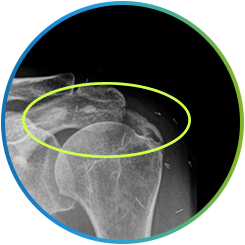 석회성 건염 부위를 타원으로 표시한 어깨 X-ray 영상