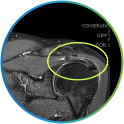석회성 건염 부위를 타원으로 표시한 어깨 MRI 영상