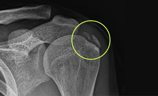 관절내시경 석회 제거 수술 전 어깨 X-ray 영상