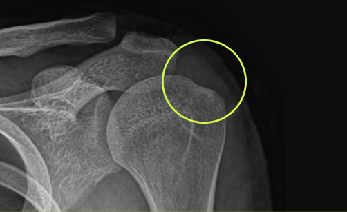 관절내시경 석회 제거 수술 후 어깨 X-ray 영상