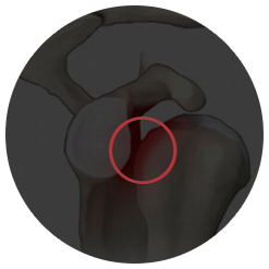어깨 관절와순 손상 부위를 붉은 원으로 표시한 일러스트