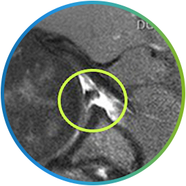 방카르트 병변 부위를 원으로 표시한 어깨 MRI 영상