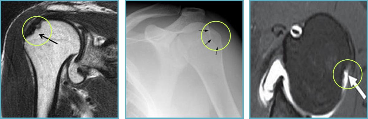 힐삭스 병변을 표시한 어깨 MRI와 X-ray 영상