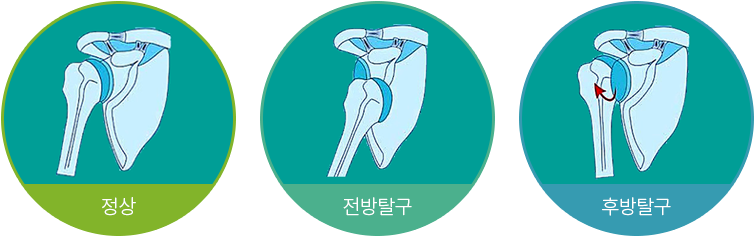 정상, 전방탈구, 후방탈구 어깨 관절 비교 일러스트