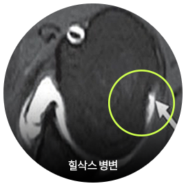힐삭스 병변을 표시한 어깨 MRI 영상