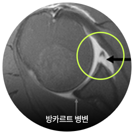 방카르트 병변을 표시한 어깨 MRI 영상