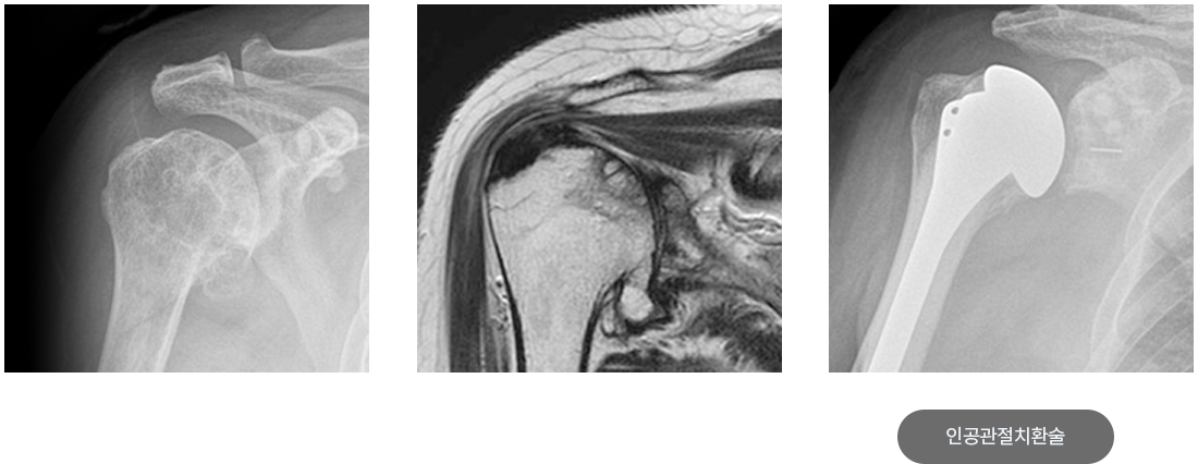 어깨 관절염 X-ray, MRI 영상과 인공관절치환술 후 X-ray 영상