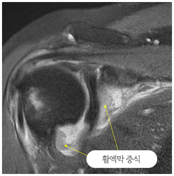 활액막 증식이 보이는 류마티스성 어깨 관절염 MRI 영상