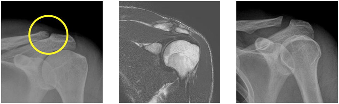 견봉쇄골관절염의 X-ray와 MRI 영상