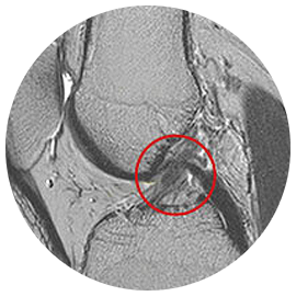 정상 전방십자인대 무릎 MRI 영상