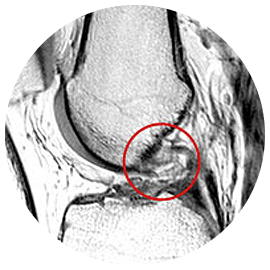 파열된 전방십자인대를 붉은 원으로 표시한 무릎 MRI 영상