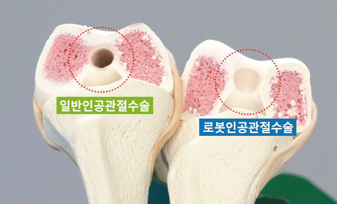 일반인공관절 수술