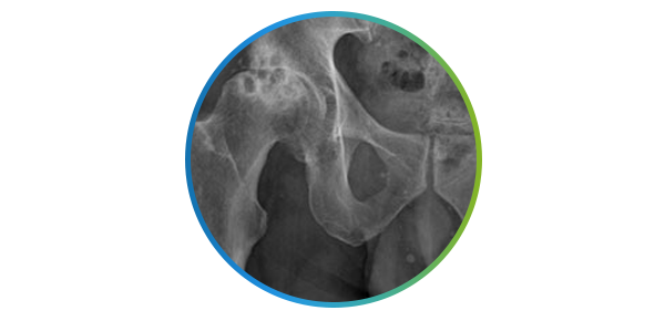 원발성 고관절염의 고관절 X-ray 영상