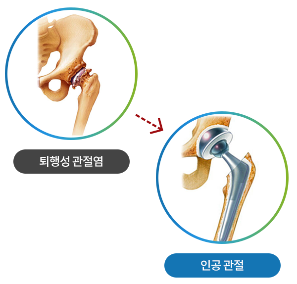 퇴행성 관절염 고관절과 인공 관절 치환 후 모습 비교 일러스트