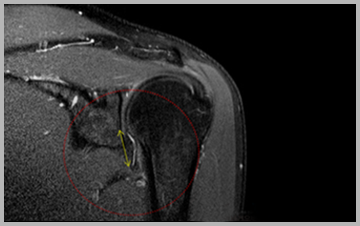 정상 어깨 관절낭 MRI 영상